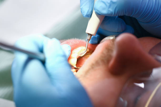 Best Emergency Tooth Extraction in Woodland Hills, UT