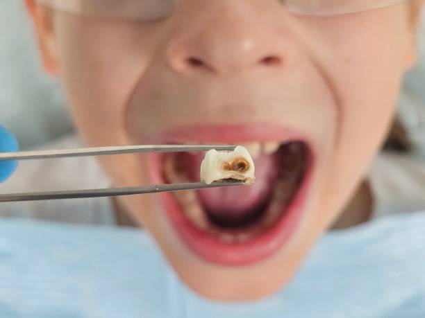 Best Emergency Wisdom Teeth Removal in Woodland Hills, UT